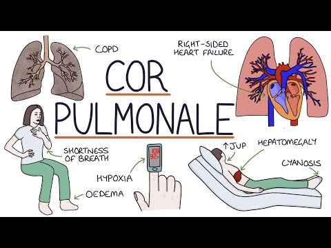 Understanding Cor Pulmonale