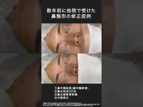 鼻中隔延長(鼻中隔軟骨)＋鼻尖形成3D法＋鼻尖部軟骨移植＋中度修正【形成外科専門医の鼻整形】他院修正症例#鼻整形 #鼻整形ダウンタイム #鼻中隔延長 #他院修正 #形成外科専門医