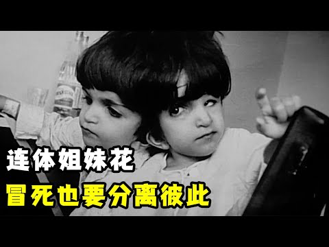 连体姐妹花，冒死也要做手术分离彼此，她们能成功吗？（纪录片）