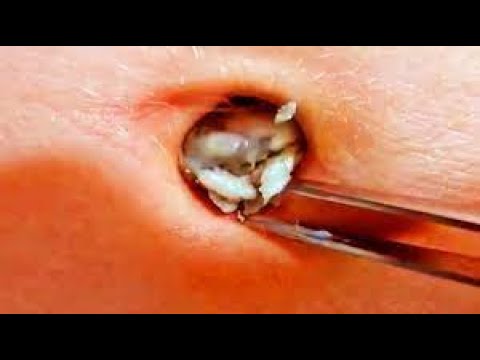 Make Your day Relaxing with new videos blackheads