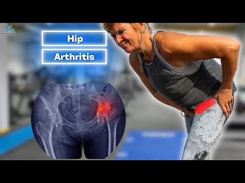 Beat Hip Osteoarthritis Pain: BEST Exercises and Treatment Insights!