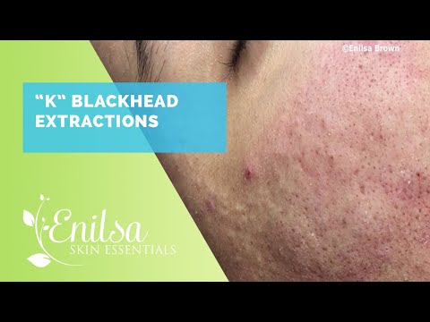 Blackhead Extractions Special "K" Another Great Video