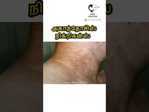 Acanthosis Nigricans | கருமையான தோல் -Dr.Isacc Abbas