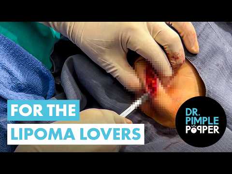 For the Lipoma Lovers