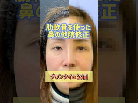 肋軟骨を使った鼻先他院修正のダウンタイム【形成外科専門医の鼻整形】 #鼻整形 #鼻中隔延長