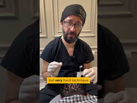 Hair Transplant by Dr. Suleyman TAS | Unshaven Technique