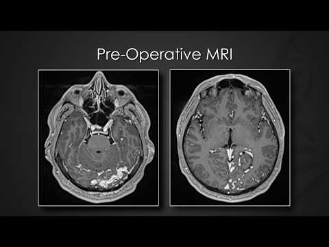 Staged transarterial endovascular embolization of malignant dAVF using Onyx & n-butyl cyanoacrylate