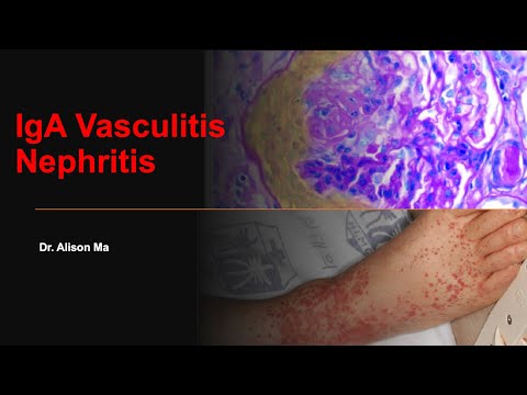 [by Request] IgA Vasculitis Nephritis (Henoch-Schönlein Purpura) by Dr. Alison Ma (6/2022)