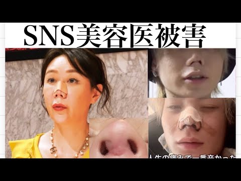 【鼻整形感染】銀座な◯えママさん、肋軟骨の鼻中隔延長をした結果SNS美容外科医の餌食に。。。