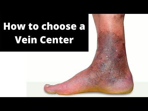 How to Choose a Vein Center