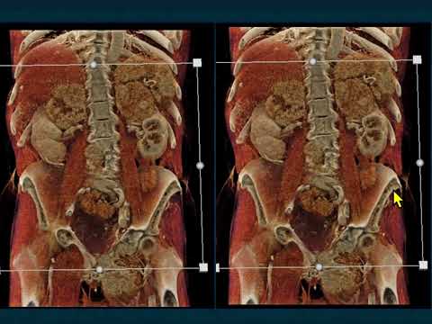 CT of the Large (greater than 4cm) Adrenal Mass: Pearls and Pitfalls - Part 4