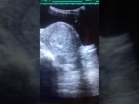 Uterus #ultrasound #sonographer #health #ultrasoundtech #science #uterus