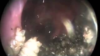 Nasal Myiasis | NEJM