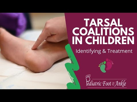 Identifying & Treating Tarsal Coalitions in Children