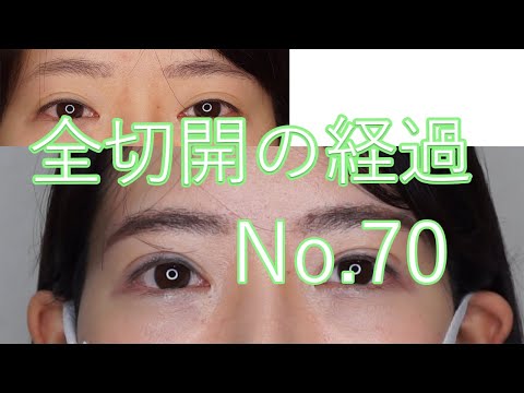 全切開二重手術＋眼瞼下垂手術　20代女性　No70