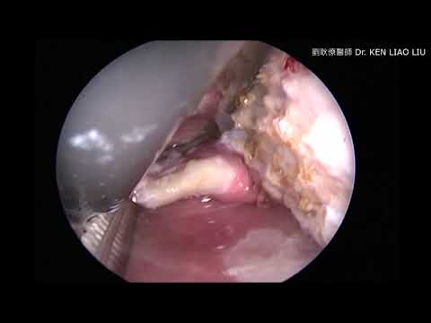 打鼾之內視鏡電漿氣化棒舌根部減容手術 ENDOSCOPIC COBLATOR ASSISTED REDUCTION OF TONGUE BASE VOLUME FOR SNORING & OSAS