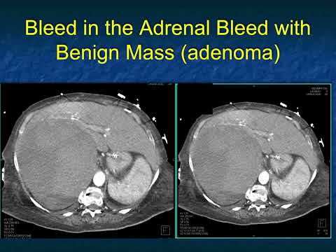 CT Evaluation of Adrenal Hemorrhage: A Challenging Diagnosis? - Part 2