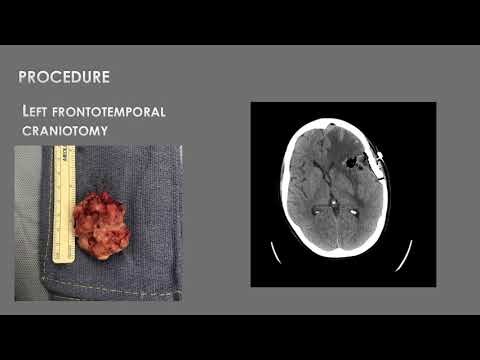 AANS Coding Shorts: Craniotomy for Resection of a Supratentorial Metastatic Brain Tumor