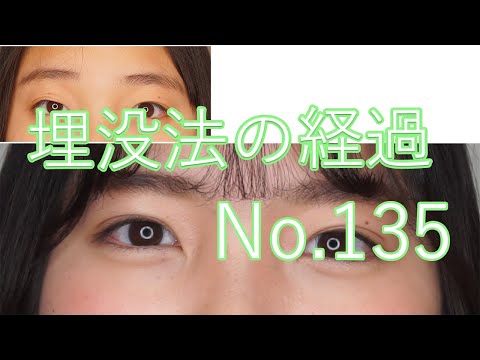 埋没法の経過　135　#short