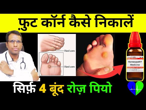 कॉर्न का इलाज कैसे करें How To Remove a Foot Corn  | फ़ुट कॉर्न कैसे निकालें Corn Treatment in hindi