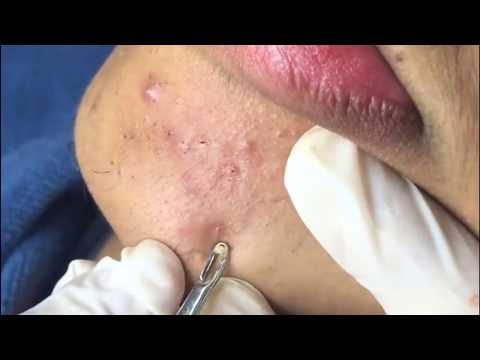 Remove Blackheads over all the face so big, Milia, Pimple Popper Videos 2019