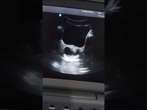 Scan of a boy with abdominal pain #abdominal #ultrasound #health #science