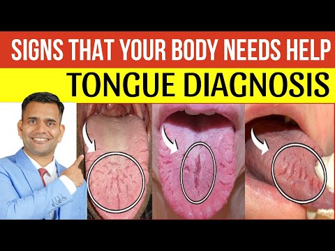 Signs That Your Body Needs Help - Tongue Diagnosis - Dr. Vivek Joshi