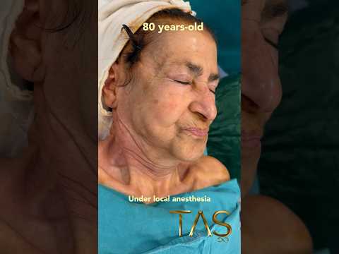 80 years-old doctor has a scarless facelift under local anesthesia #profdrsuleymantas