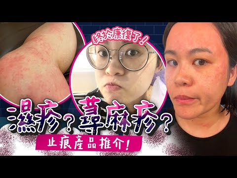 10款濕疹敏感肌產品評測｜搽類固醇腫面😭  慢性風癩痕到崩潰｜誤當濕疹皮炎醫｜救星醫生｜止痕好物｜頭皮保養｜產品評價｜蕁麻疹｜產後身體