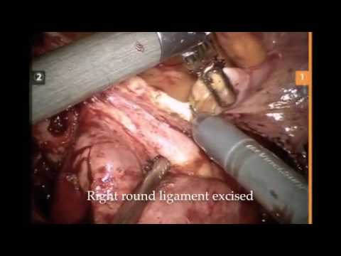 Robotic hysterectomy for endometriosis Dr Rooma Sinha Gynecologist Apollo Hospital   YouTube 360p