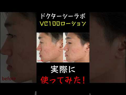 ドクターシーラボVC100ローションを1ヶ月使ってみた効果と経過！ニキビ・毛穴・ニキビ跡に効いた？ #shorts