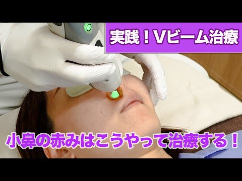 【Vビームレーザー施術動画】小鼻の赤みはこうやって治療する！