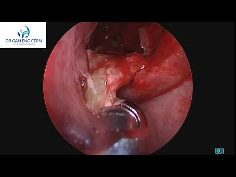 THICK MUCOUS FROM YOUR NOSE OF PHLEGM?