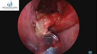 THICK MUCOUS FROM YOUR NOSE OF PHLEGM?