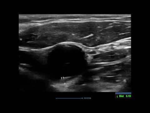 Small carotid plaque in the left carotid bulb with thickness of 2 mm