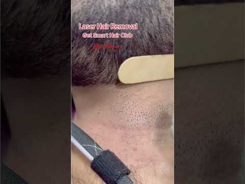 Laser Hair Removal #getsmarthairclub #viralvideo