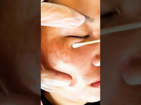 face Clean treatment