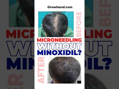 Microneedling WITHOUT Minoxidil - Does it work? #minoxidil