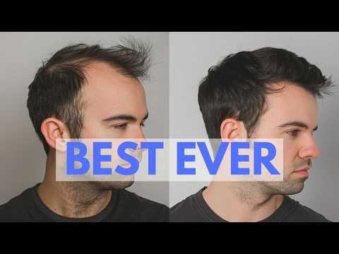 TOP 10 Hair Loss Treatments - Ranked by New Hair Growth!