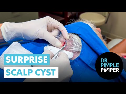 A Surprise Scalp Cyst