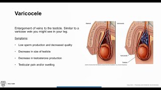 Varicocele Overview & Treatment