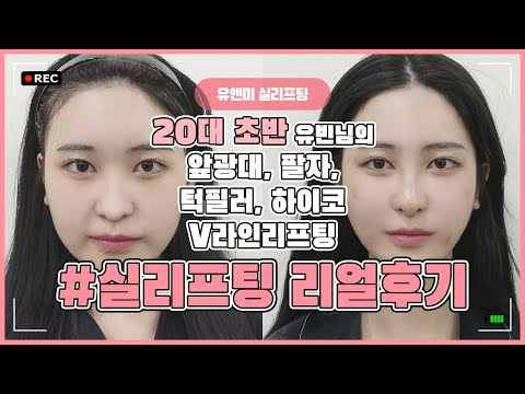 [ 리얼후기 ] 20대실리프팅 / 턱필러 / 하이코 / 앞광대필러 / 팔자주름필러 / 이중턱리프팅