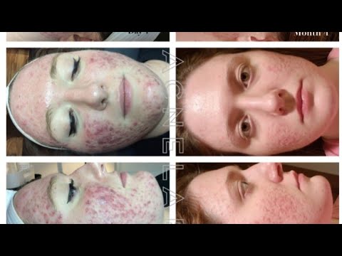 Get Rid of Acne Fast! Tips on Acne Treatment and How to Get Rid of Pimples Fast!