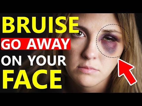 How to Get Rid of Bruises | 10 Bruise Treatment & Home Remedies.