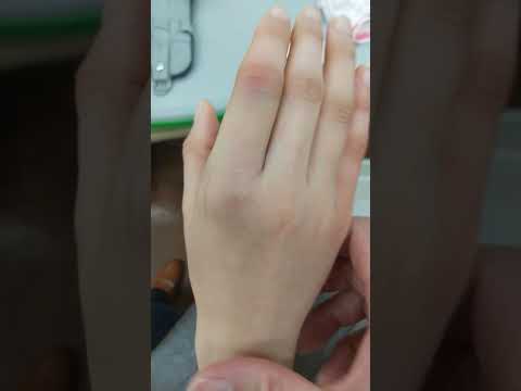 指の骨折疑い 　春日部　ときだ接骨院鍼灸院  finger fracture