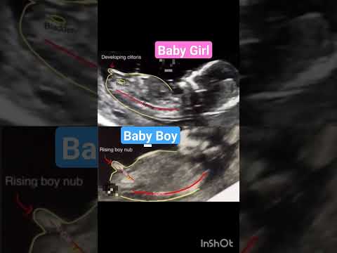 nub theory Gender Reveal ultrasound scan #nubtheory #genderpredictions