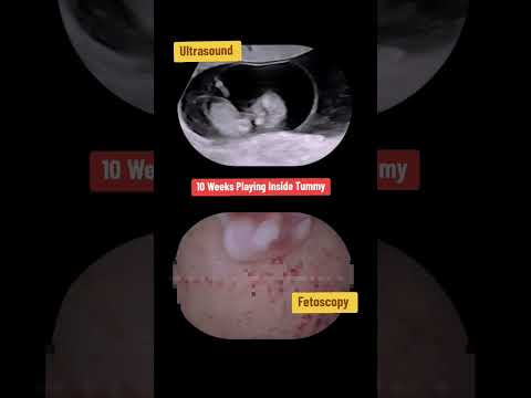 10 Weeks playing Inside Womb #babyultrasound #pregancyultrasound #pregnancyscan #pregnant