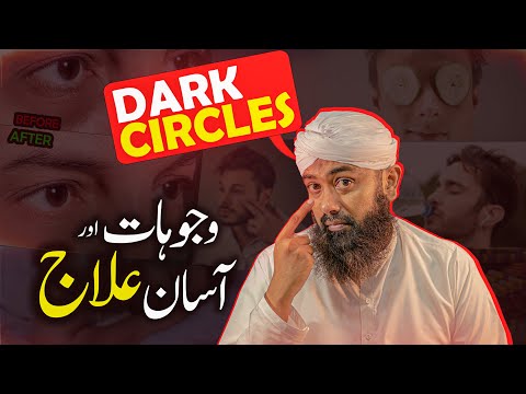 Ankhon Ke Halky Khatam Karny Ka Tarika | How to Remove Dark Circles Naturally | Soban Attari