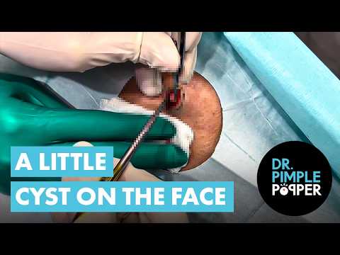 A Little Cyst on the Face