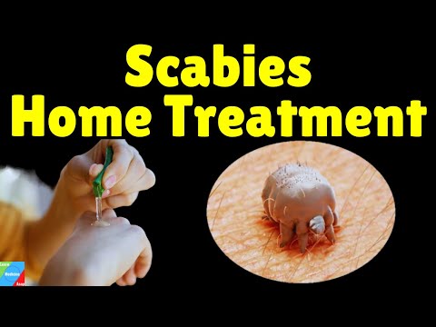 Scabies Home Treatment | Home Remedies for Scabies to Speed Up Treatment | How to Treat Scabies